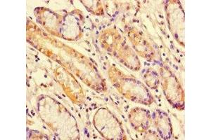 Immunohistochemistry of paraffin-embedded human gastric cancer using ABIN7169664 at dilution of 1:100 (STAT1 antibody  (AA 63-196))
