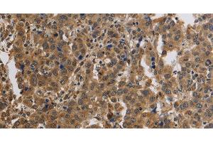 Immunohistochemistry of paraffin-embedded Human liver cancer using KCNMB4 Polyclonal Antibody at dilution of 1:40 (KCNMB4 antibody)