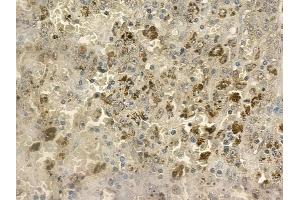 ABIN6258777 and ABIN6273394 at 1/100 staining human melanoma by IHC-P. (CCL24 antibody  (C-Term))