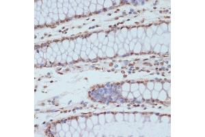 Immunohistochemistry of paraffin-embedded human colon using Phospho-CDK1-Y15 antibody (ABIN3019442, ABIN3019443, ABIN3019444 and ABIN6225371) at dilution of 1:100 (40x lens). (CDK1 antibody  (pTyr15))