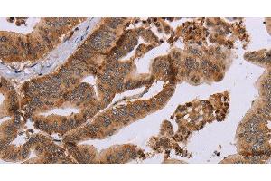 Immunohistochemistry of paraffin-embedded Human gastric cancer tissue using MFAP5 Polyclonal Antibody at dilution 1:40 (MFAP5 antibody)