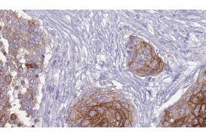 ABIN6277266 at 1/100 staining Human urothelial cancer tissue by IHC-P. (FCGR3A antibody  (C-Term))