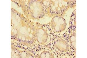 Immunohistochemistry of paraffin-embedded human colon cancer using ABIN7171095 at dilution of 1:100 (SYN1 antibody  (AA 113-420))