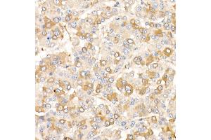 Immunohistochemistry of paraffin-embedded human liver cancer using /AMID Rabbit pAb (ABIN6129888, ABIN6136678, ABIN6136679 and ABIN6215707) at dilution of 1:25 (40x lens).