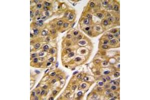 Formalin-fixed and paraffin-embedded human hepatocarcinoma tissue reacted with IDH1 antibody (Center), which was peroxidase-conjugated to the secondary antibody, followed by DAB staining. (Isocitrate Dehydrogenase antibody  (Middle Region))