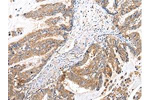 The image on the left is immunohistochemistry of paraffin-embedded Human esophagus cancer tissue using ABIN7193079(XKRX Antibody) at dilution 1/25, on the right is treated with synthetic peptide. (XKRX antibody)