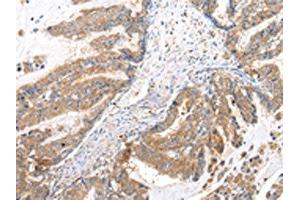 The image on the left is immunohistochemistry of paraffin-embedded Human esophagus cancer tissue using ABIN7193079(XKRX Antibody) at dilution 1/25, on the right is treated with synthetic peptide.
