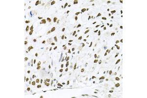 Immunohistochemistry of paraffin-embedded human lung cancer using MAPK8 antibody at dilution of 1:100 (x40 lens). (JNK antibody)