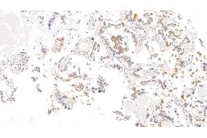 Detection of CK17 in Human Lung cancer Tissue using Monoclonal Antibody to Cytokeratin 17 (CK17) (KRT17 antibody  (AA 252-393))