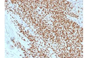 Formalin-fixed, paraffin-embedded human Ewing's Sarcoma stained with NKX2. (Recombinant Nkx2-2 antibody  (AA 1-119))