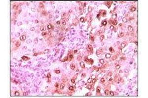 Immunohistochemical analysis of paraffin-embedded human brain glioma tissue showing nuclear localization using calcyclin mouse mAb with DAB staining. (S100A6 antibody)