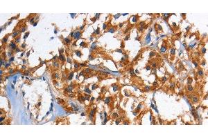 Immunohistochemistry of paraffin-embedded Human thyroid cancer using HK2 Polyclonal Antibody at dilution of 1:60 (Hexokinase 2 antibody)