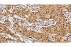 Immunohistochemistry of paraffin-embedded Human gastic cancer using ARHGAP25 Polyclonal Antibody at dilution of 1:40 (ARHGAP25 antibody)