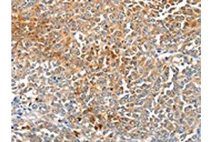 The image on the left is immunohistochemistry of paraffin-embedded Human ovarian cancer tissue using ABIN7191349(MAGEB2 Antibody) at dilution 1/40, on the right is treated with synthetic peptide. (MAGEB2 antibody)