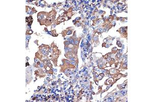 Immunohistochemistry of paraffin-embedded human lung cancer using VPS11 Rabbit mAb (ABIN7271272) at dilution of 1:100 (40x lens). (VPS11 antibody)