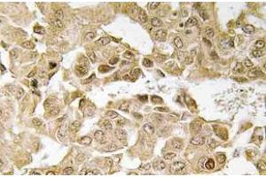 Immunohistochemistry (IHC) analyzes of MEK1 antibody in paraffin-embedded human breast carcinoma tissue. (MEK1 antibody)