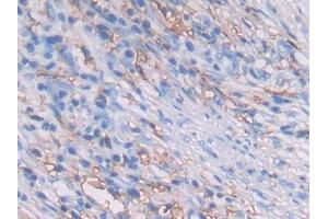 DAB staining on IHC-P; Samples: Human Lung cancer Tissue (HLA-DRB1 antibody  (AA 30-266))