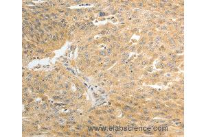 Immunohistochemistry of Human ovarian cancer using AKR1C1 Polyclonal Antibody at dilution of 1:30