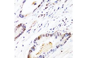 Immunohistochemistry of paraffin-embedded human colon carcinoma using FGF12 antibody (ABIN3016419, ABIN3016420, ABIN1679841 and ABIN6219744) at dilution of 1:150 (40x lens).