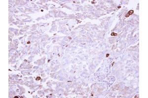 IHC-P Image Immunohistochemical analysis of paraffin-embedded human lung adenocarcinoma Macrophage, using VAP1, antibody at 1:250 dilution. (AOC3 antibody)