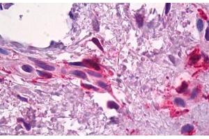 Anti-F13A1 / Factor XIIIa antibody IHC staining of human skin, dermal inflammatory cells. (F13A1 antibody)