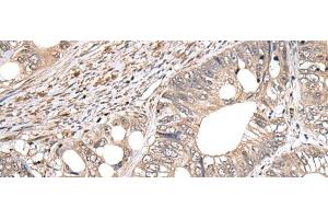 Immunohistochemistry of paraffin-embedded Human colorectal cancer tissue using GCNT2 Polyclonal Antibody at dilution of 1:60(x200) (GCNT2 antibody)
