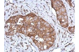 IHC-P Image Immunohistochemical analysis of paraffin-embedded human breast cancer, using CD97, antibody at 1:500 dilution. (CD97 antibody)