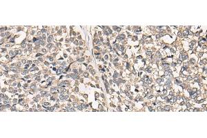 Immunohistochemistry of paraffin-embedded Human esophagus cancer tissue using C12orf40 Polyclonal Antibody at dilution of 1:50(x200) (C12orf40 antibody)