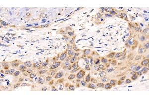 Detection of MCL1 in Human Lung cancer Tissue using Polyclonal Antibody to Induced Myeloid Leukemia Cell Differentiation Protein Mcl-1 (MCL1) (MCL-1 antibody  (AA 2-307))
