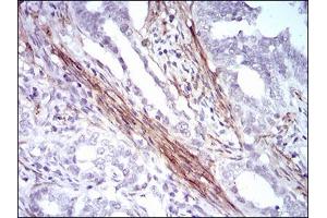 Immunohistochemical analysis of paraffin-embedded cervical cancer tissues using CNN1 mouse mAb with DAB staining. (CNN1 antibody  (AA 16-165))