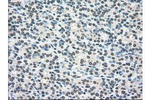 Immunohistochemical staining of paraffin-embedded Adenocarcinoma of colon tissue using anti-SCYL3mouse monoclonal antibody. (SCYL3 antibody)