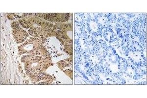 Immunohistochemistry analysis of paraffin-embedded human colon carcinoma tissue, using ZC3H8 Antibody. (ZC3H8 antibody  (AA 81-130))