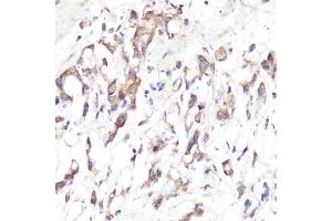 Immunohistochemistry of paraffin-embedded human gastric cancer using SELL antibody (ABIN3022263, ABIN3022264, ABIN3022265 and ABIN6218704) at dilution of 1:100 (40x lens).