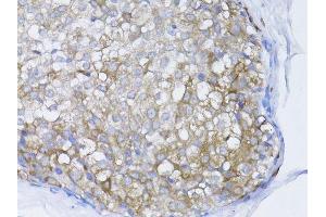 Immunohistochemistry of paraffin-embedded human breast cancer using BRCA1 antibody. (BRCA1 antibody  (AA 120-220))