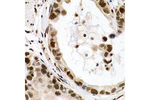 Immunohistochemistry of paraffin-embedded human stomach cancer using MT2A antibody at dilution of 1:200 (400x lens). (MT2A antibody)