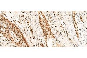 Immunohistochemistry of paraffin-embedded Human esophagus cancer tissue using RMND5B Polyclonal Antibody at dilution of 1:50(x200) (RMND5B antibody)