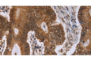 Immunohistochemistry of paraffin-embedded Human colon cancer tissue using ERCC6L Polyclonal Antibody at dilution 1:30 (ERCC6L antibody)