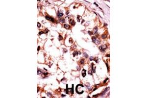 Formalin-fixed and paraffin-embedded human cancer tissue reacted with the primary antibody, which was peroxidase-conjugated to the secondary antibody, followed by AEC staining. (MAPK6 antibody  (pSer189))