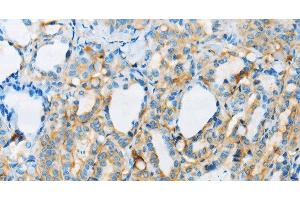 Immunohistochemistry of paraffin-embedded Human thyroid cancer tissue using ARSA Polyclonal Antibody at dilution 1:50 (Arylsulfatase A antibody)