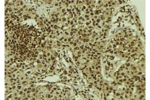 ABIN6278630 at 1/100 staining Human breast cancer tissue by IHC-P. (URI1 antibody  (Internal Region))