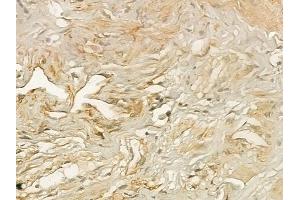 ABIN6258113 and ABIN6273354 at 1/100 staining human testicular cancer by IHC-P. (DIRAS3 antibody  (C-Term))