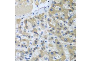 Immunohistochemistry of paraffin-embedded human liver cancer using XPC antibody.