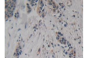 Detection of NSE in Human Breast cancer Tissue using Polyclonal Antibody to Enolase, Neuron Specific (NSE) (ENO2/NSE antibody  (AA 2-285))