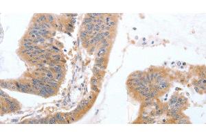 Immunohistochemistry of paraffin-embedded Human colon cancer tissue using TGFA Polyclonal Antibody at dilution 1:60 (TGFA antibody)
