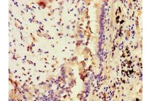 Immunohistochemistry of paraffin-embedded human lung cancer using ABIN7169671 at dilution of 1:100 (STAT2 antibody  (AA 571-851))