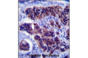 ZDHHC24 Antibody (C-term) (ABIN657453 and ABIN2846480) immunohistochemistry analysis in formalin fixed and paraffin embedded human bladder carcinoma followed by peroxidase conjugation of the secondary antibody and DAB staining. (ZDHHC24 antibody  (C-Term))