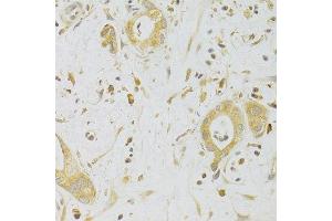 Immunohistochemistry of paraffin-embedded human liver cancer using CASP2 Antibody. (Caspase 2 antibody  (AA 153-452))