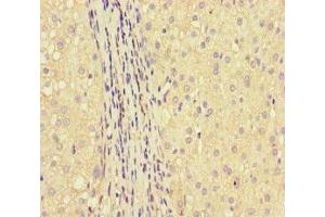 Immunohistochemistry of paraffin-embedded human liver cancer using ABIN7154022 at dilution of 1:100 (GLUL antibody  (AA 86-373))