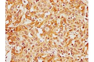 IHC image of ABIN7148386 diluted at 1:400 and staining in paraffin-embedded human liver cancer performed on a Leica BondTM system. (CFHR1 antibody  (AA 132-221))