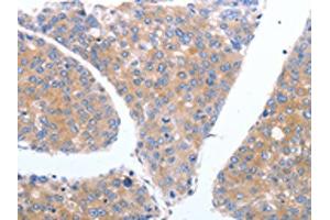 The image on the left is immunohistochemistry of paraffin-embedded Human breast cancer tissue using ABIN7190790(GFRA4 Antibody) at dilution 1/40, on the right is treated with synthetic peptide. (GFRA4 antibody)